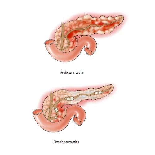 acute-and-chronic-pancreatitis