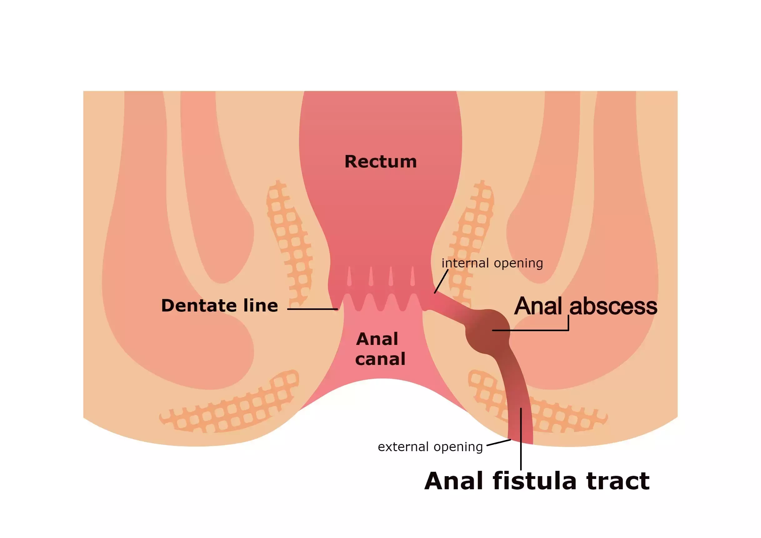 anal-fistula-with-labelling