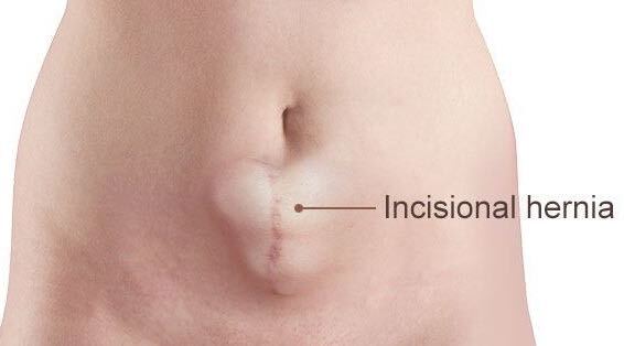  Incisional Hernia ? Causes,Symptoms,Treatment