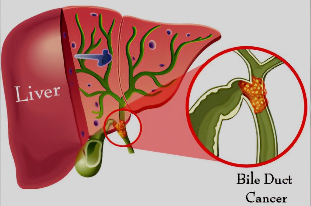 bile-duct-cancer