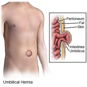 Anal Umbilical Hernia? Causes,Symptoms,Treatment