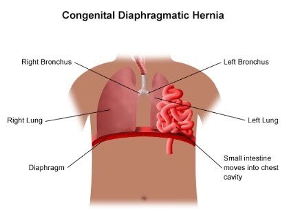 Diaphragmatic Hernia ? Causes,Symptoms,Treatment
