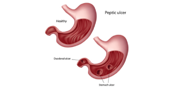 gastric-ulcer