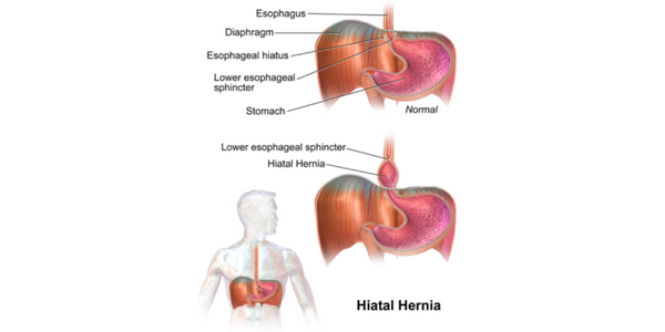 Hiatal Hernia ? Causes,Symptoms,Treatment