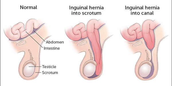 Anal Inguinal Hernia? Causes,Symptoms,Treatment