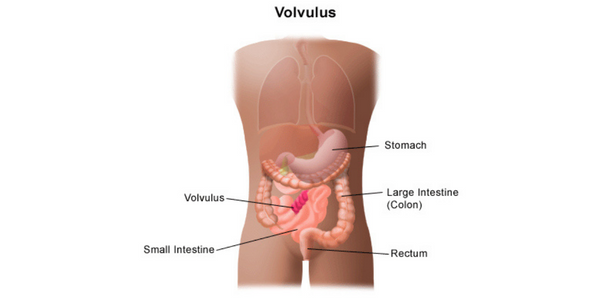 volvulus