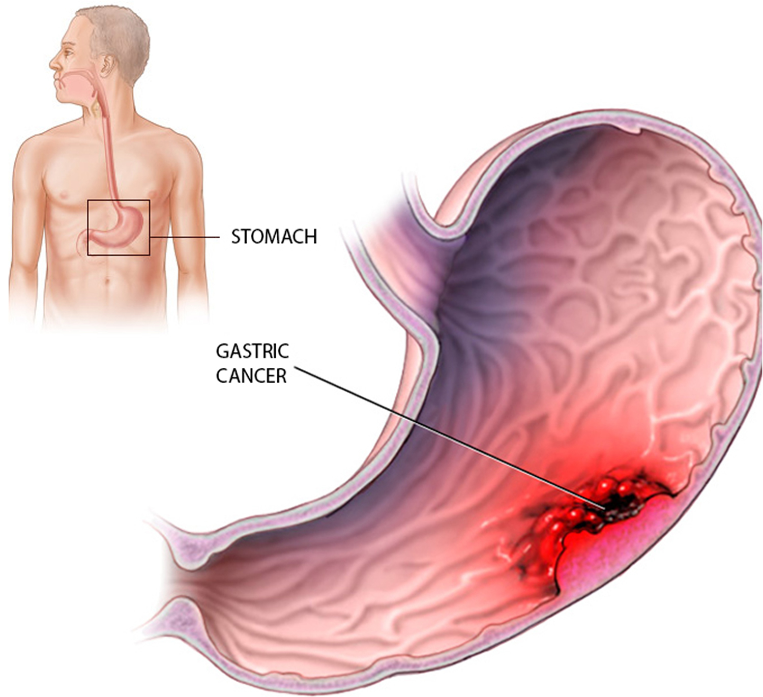 stomach-cancer